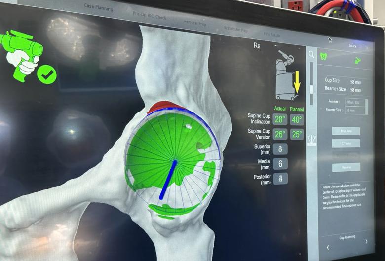 Screen showing robotic planning of hip replacement