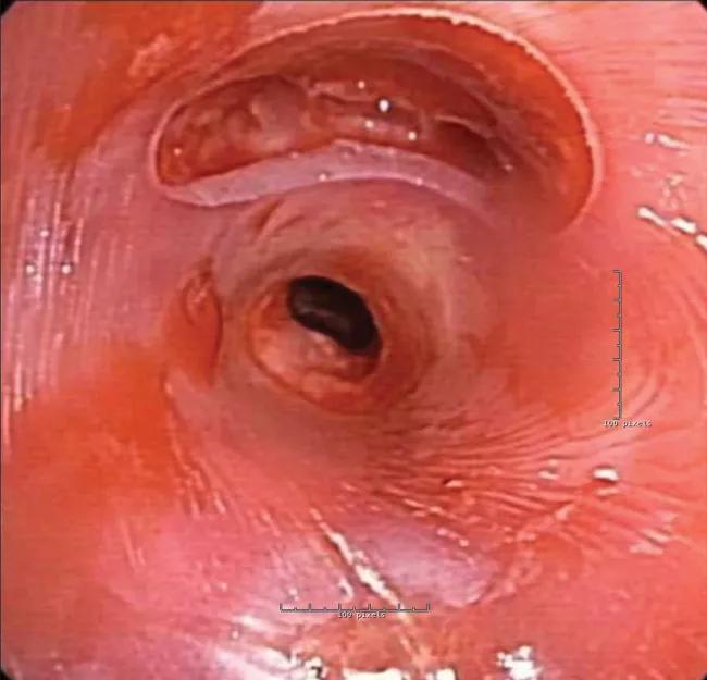 View of right main bronchus with a hole cut for the right upper lobe.