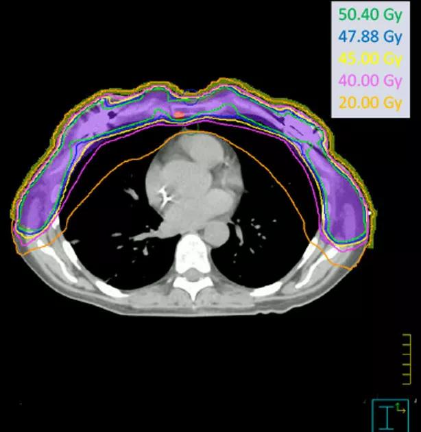 This planning CT scan of a bilateral breast cancer patient shows radiation exposure levels and was designed by the Medical Dosimetry team at Cleveland Clinic. At the time of publication, the patient remains disease free with fully functional organs