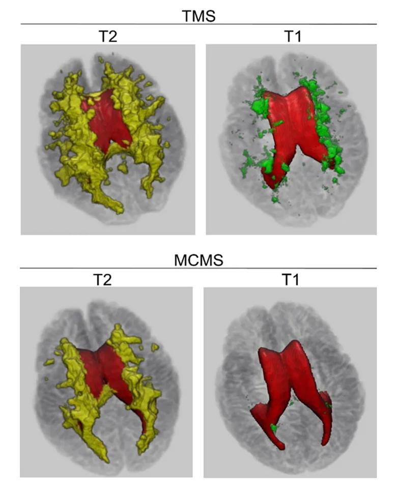 3D maps of T2 and T1 imaging in postmortem brains with multiple sclerosis