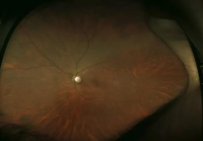  A large retinal detachment is seen with subretinal fluid extending right up to the optic disc.