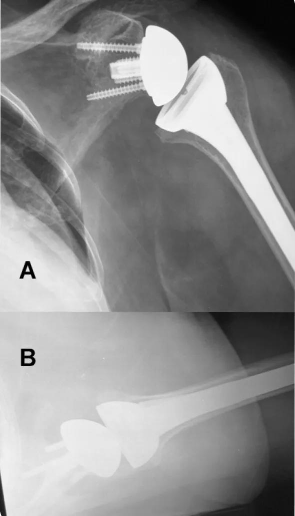 Figure 2 Anteroposterior (A) and axillary (B) plain radiographs of a reverse total shoulder replacement demonstrate how a metal hemisphere is placed on the old socket, while a metal and plastic socket replaces the old ball. 