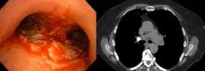 Bronchoscopy