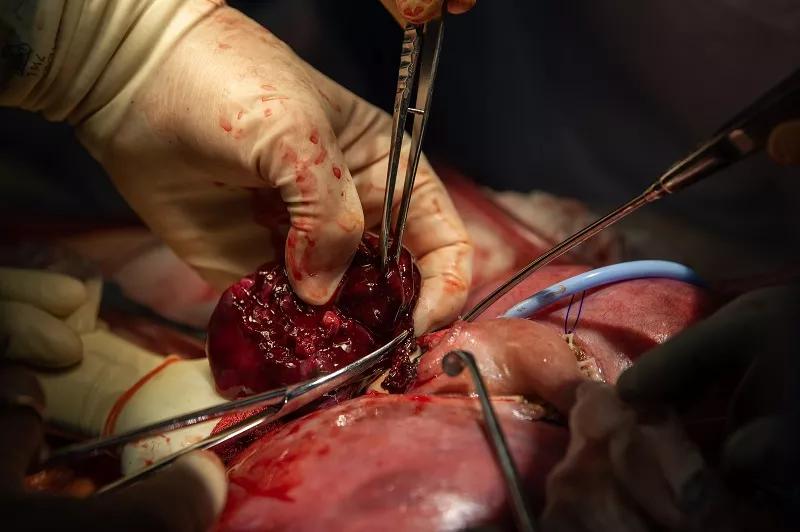 Dr. Cass carefully resects the massive fetal lung malformation.
