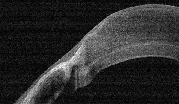 Figure 3: Three months after surgery, an intact cornea and clear DSEK graft can be seen.