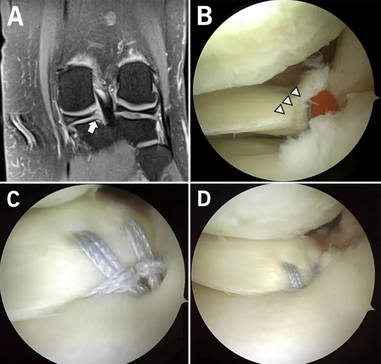 Repairing a torn meniscal root 