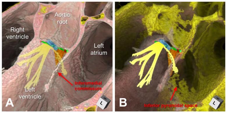 Anatomy of left ventricular outflow tract