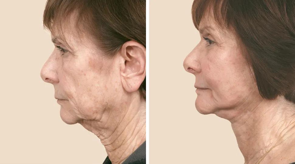 Facelift before & after photo