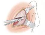 I. Closure of anterior rectus sheath