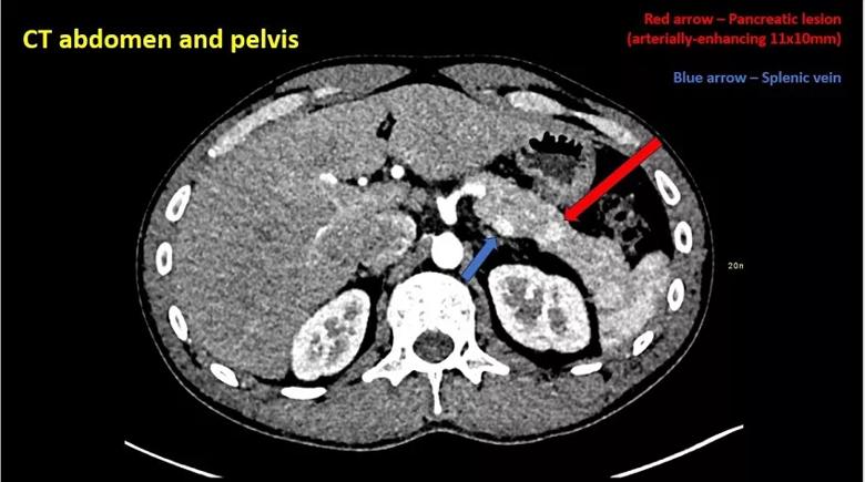 CT image of lesion.
