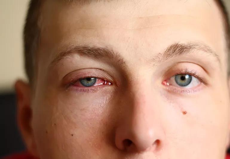 How to get rid of yellow eyes: Treatment and home remedies