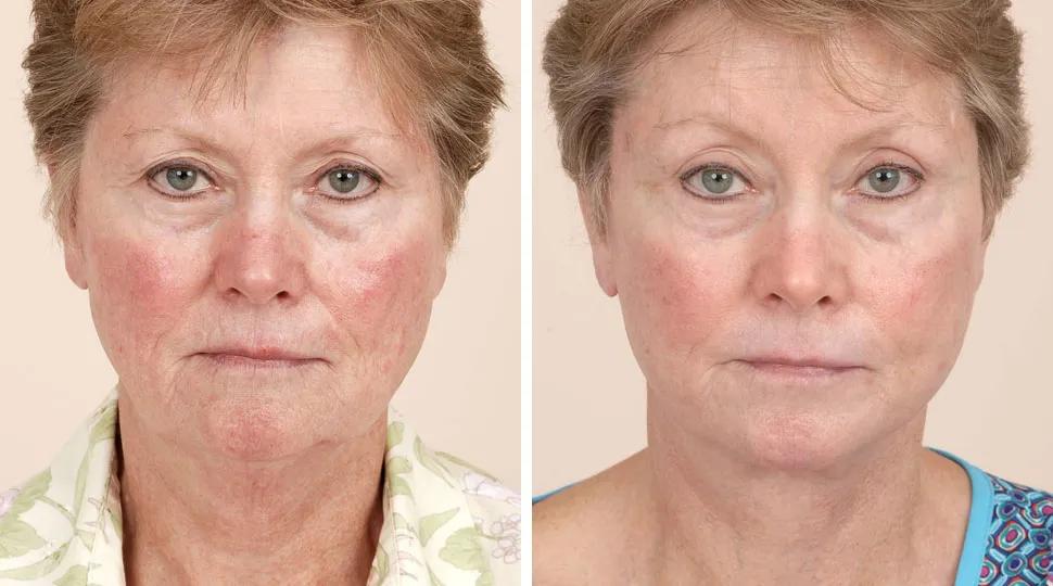 Facelift before & after photo