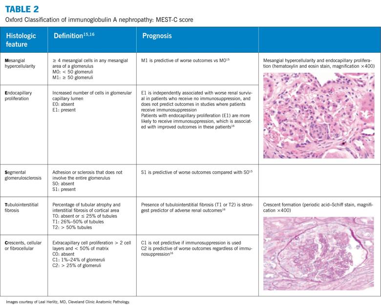 Table 2. Oxford classification of immunoglobulin A nephropathy: MEST-C score