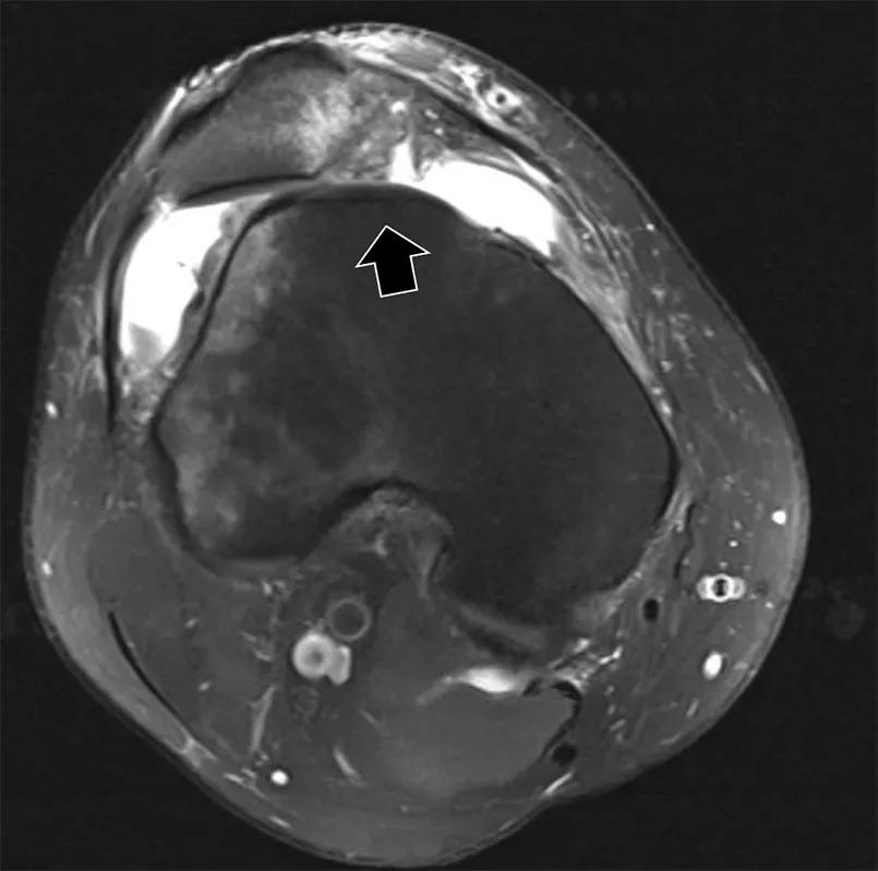 Image of a flat trochlear groove