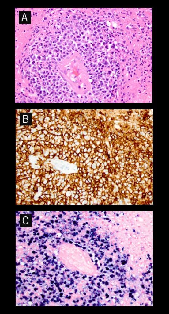 Hematoxylin and eosin stain shows atypical perivascular cells