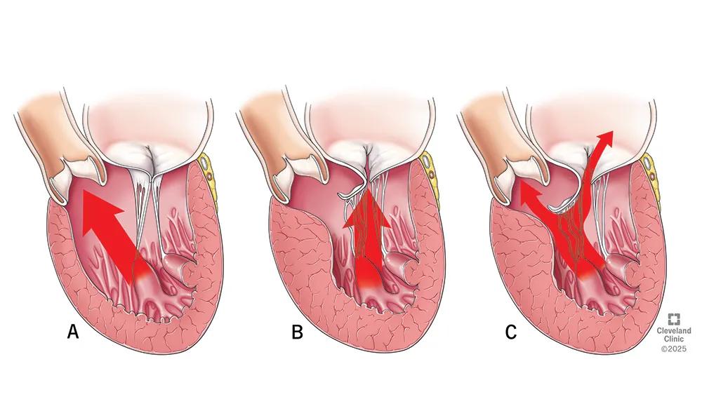 Septal hypertrophy illustration