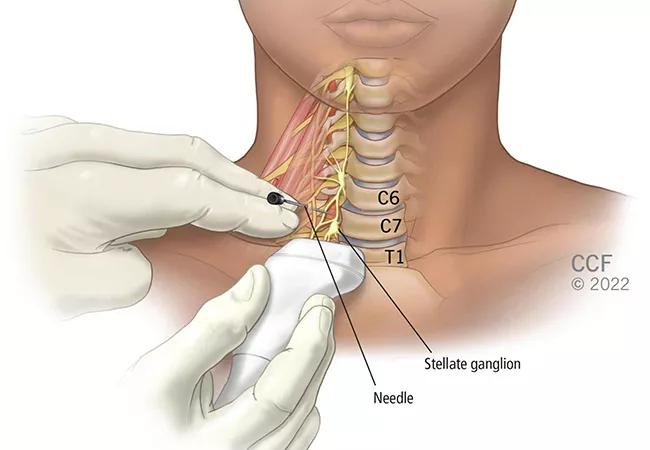 Nerve Block Shows Promise for Long COVID-Related Olfactory or Gustatory  Dysfunction