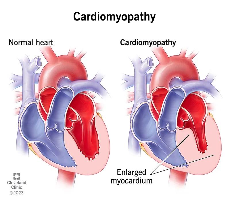 A heart with cardiomyopathy compared to a normal heart