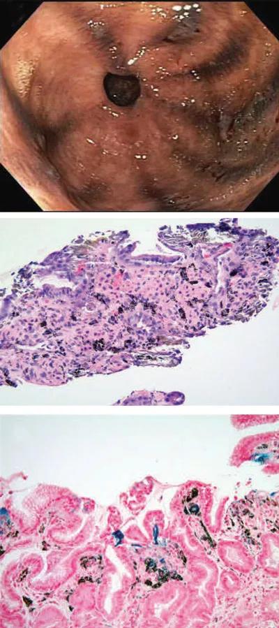 Images of gastric antral psudeomelanosis