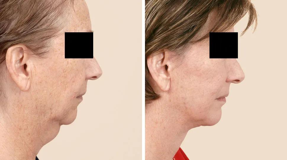 Facelift before & after photo
