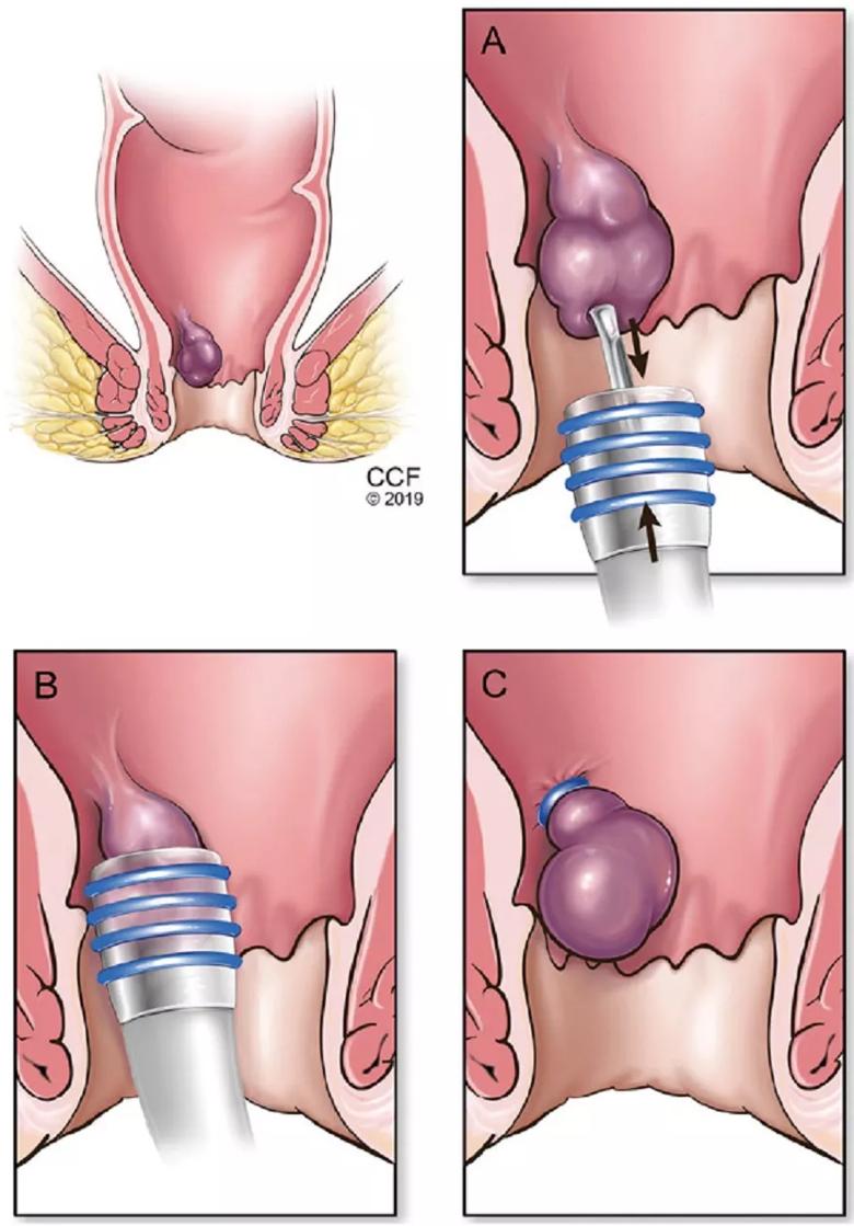 Inguinal Hernia - Orange County Hemorrhoid Clinic