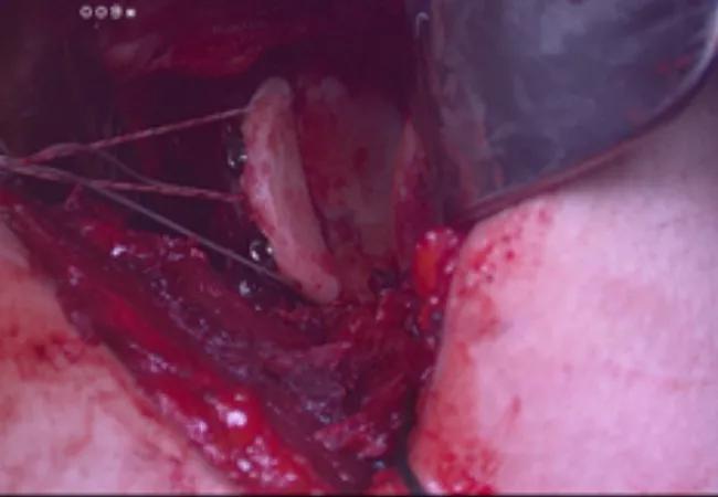 Bone graft fixed in place with two screws