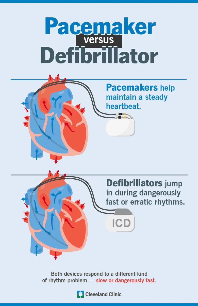 Pacemaker vs. defibrillator, what they both do for heart rhythm problems