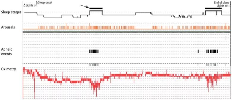 Sleep study overview showing rapid eye movement with increased arousals and apneic events and decreased oxygen levels.