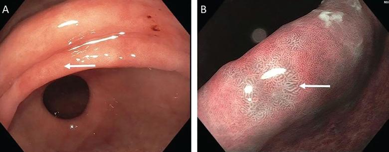 Endoscopic appearance of gastric intestinal metaplasia