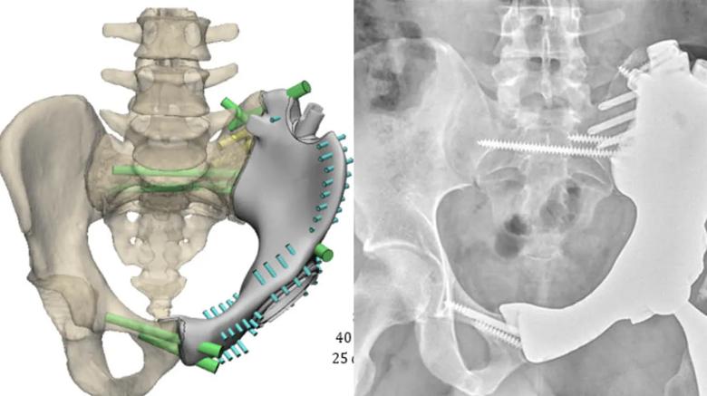 3D-printed pelvic implant