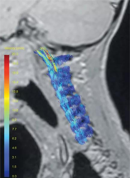 Chiari-fig2a