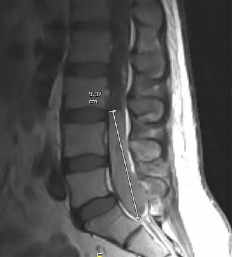 MRI showing a spinal ependymoma