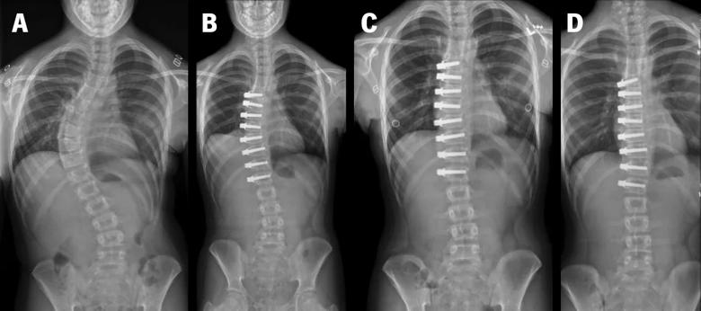 Progression of scoliosis correction with vertebral body tethering