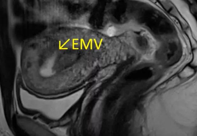 Scan shows 2.7-cm mass-like projection into the right anterolateral myometrium.