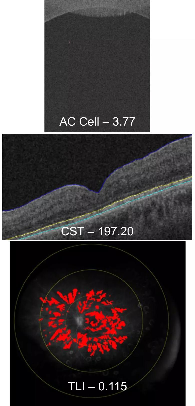 Imaging of patient with intraocular inflammation