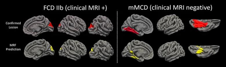 series of brain images with grooves, ridges and colored portions against black background