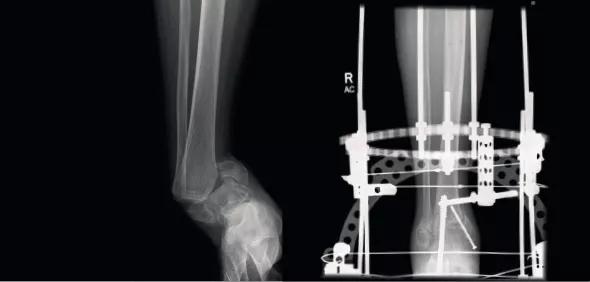 Figure 2. (A) Severe supination-adduction fracture dislocation in a 61-year-old diabetic female with a history of Charcot neuroarthropathy on the contralateral side. (B) Successful stabilization with a transarticular screw and an Ilizarov external fixator. 