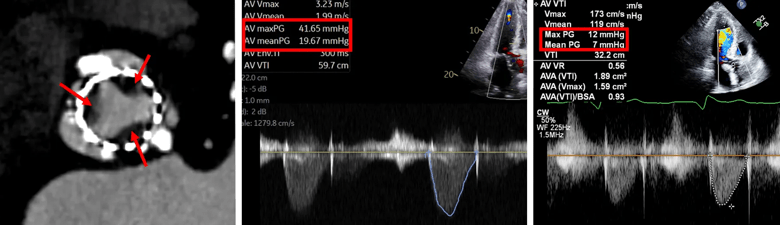 imaging study of heart valve next to two echocardiograms