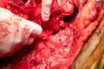 Surgeons carefully resect the patient's diseased organs.