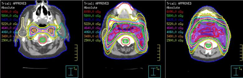 Reirradiation plan demonstrating various isodose lines and target in purple covered by the 58 Gy isodose line