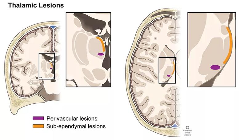 thalamic lesions in multiple sclerosis