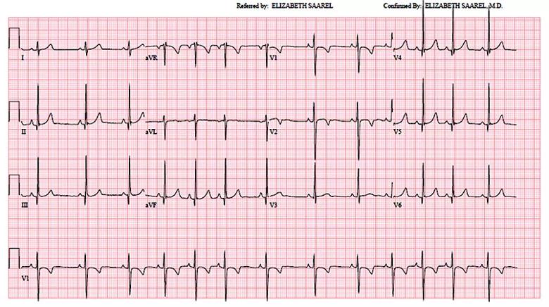 Figure. A normal ECG from a 9-year-old boy without heart disease. 