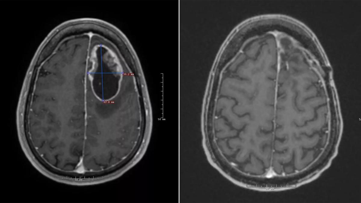 brain cancer immunotherapy Cleveland Clinic