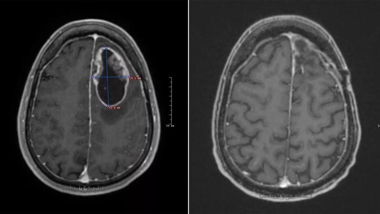 brain cancer immunotherapy Cleveland Clinic