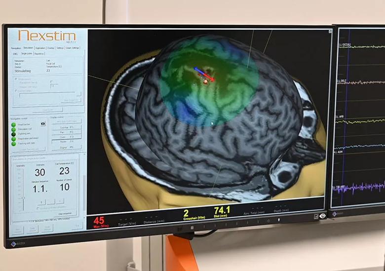 navigated transcranial magnetic stimulation for epilepsy evaluation