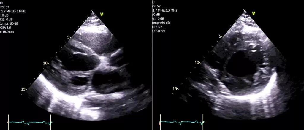 side-by-side echocardiograms
