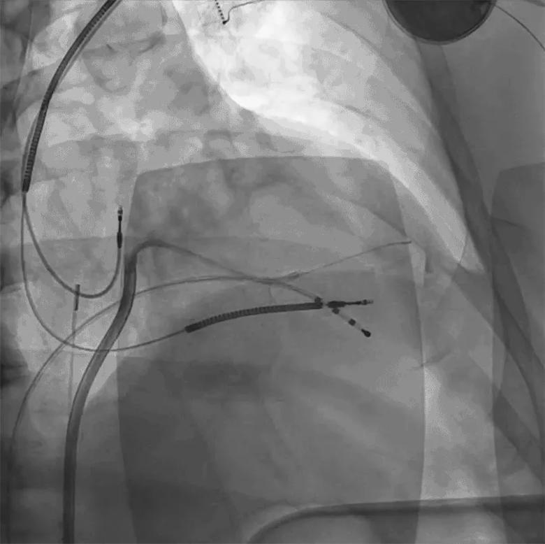 Example of pericardial adhesions in the posterolateral left ventricle