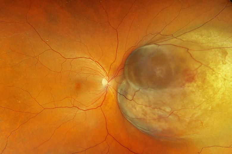 Uveal melanoma