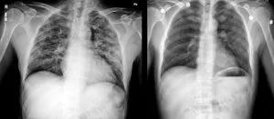 Chest images from a patient who ended up in the ICU with suspected lung injury related to vaping.