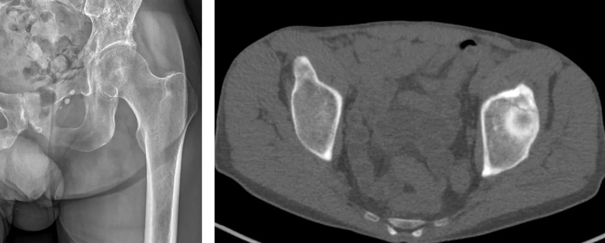 X-ray and CT images of hip fracture
